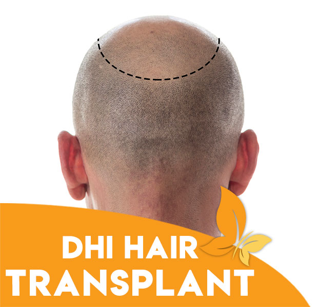 DHI Hair Transplant | Bariest